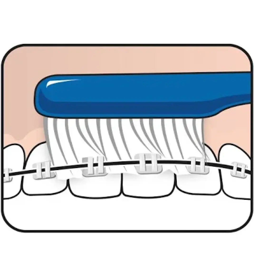 Tepe Diş Fırçası Implant Orthodontic