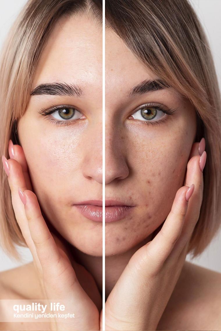 Quality Life Akne Karşıtı Serum - Akne Temizleme - Siyah Nokta Gözenek Temizleyici - İzi ve Kurutucu Serumu