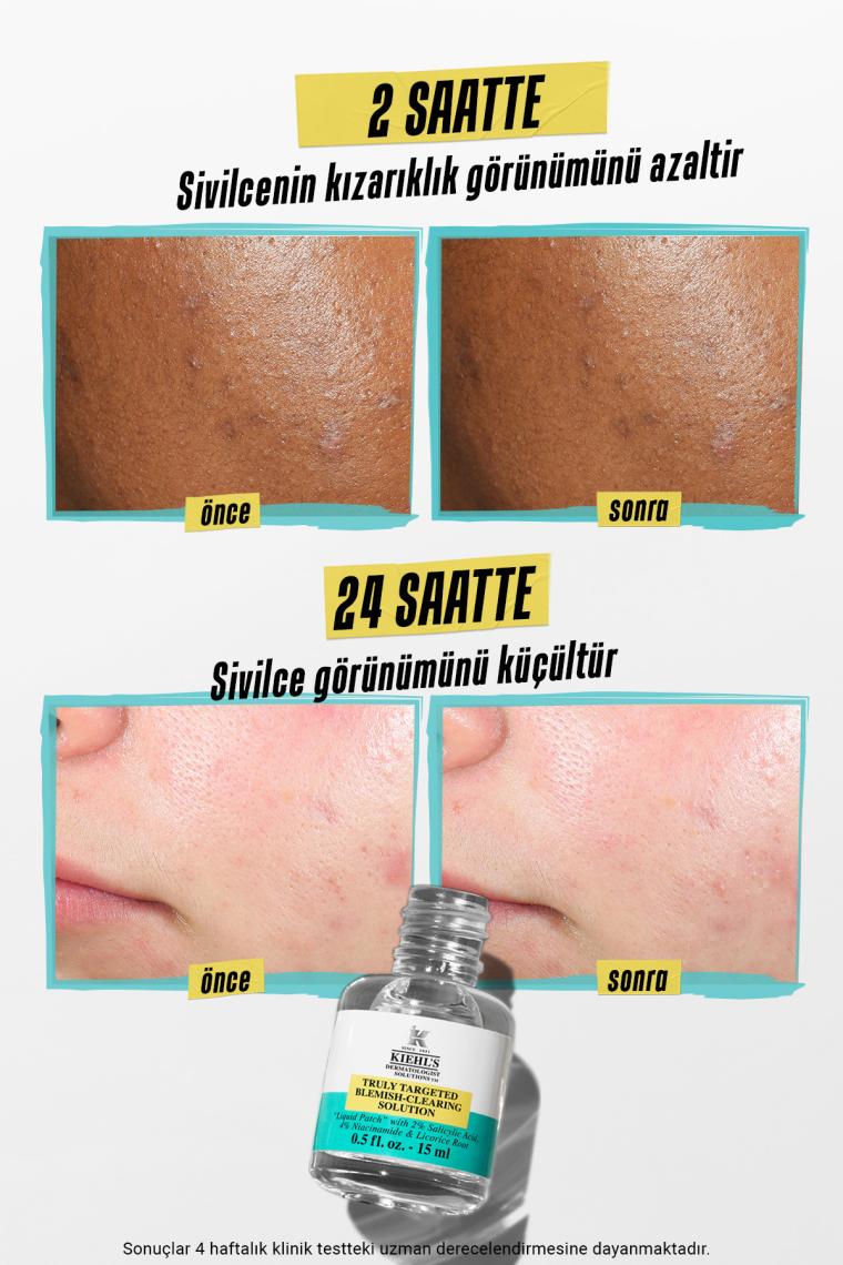 Kiehl'S Truly Targeted Blemish-Clearing Solution 15 Ml - Serum