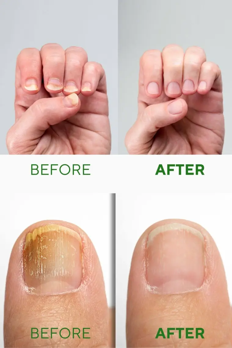 Ceelini El ve Ayak Tırnak Besleyici Güçlendirici Serum Çay Ağacı ve Salisik Asit Özlü 30 ml