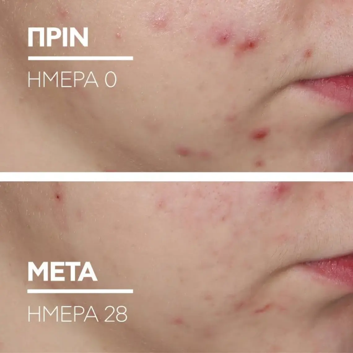 La Roche-Posay Effaclar Duo(+) Bakım Kremi Kusur Karşıtı Akneye Eğilim Gösteren Ciltler 40Ml