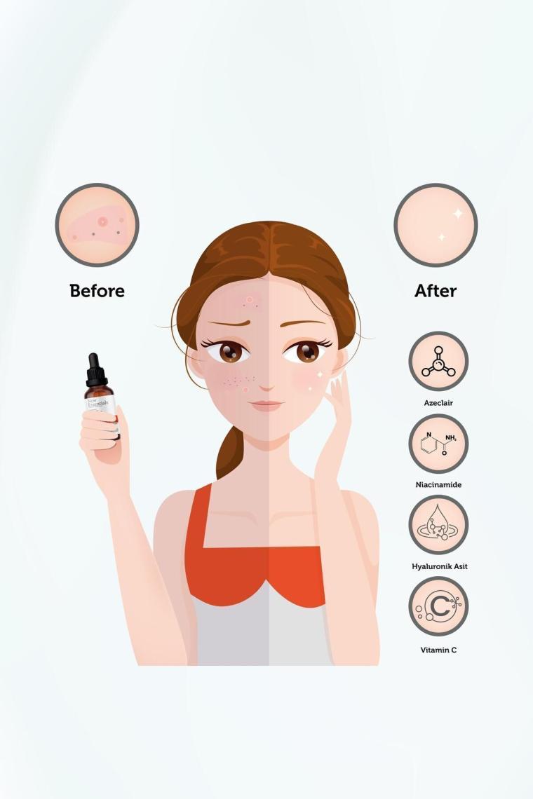Ton Eşitleme, Gözenek Siyah Nokta Ve Sivilce Oluşumunu Gidermeye Yardımcı Süper Serum