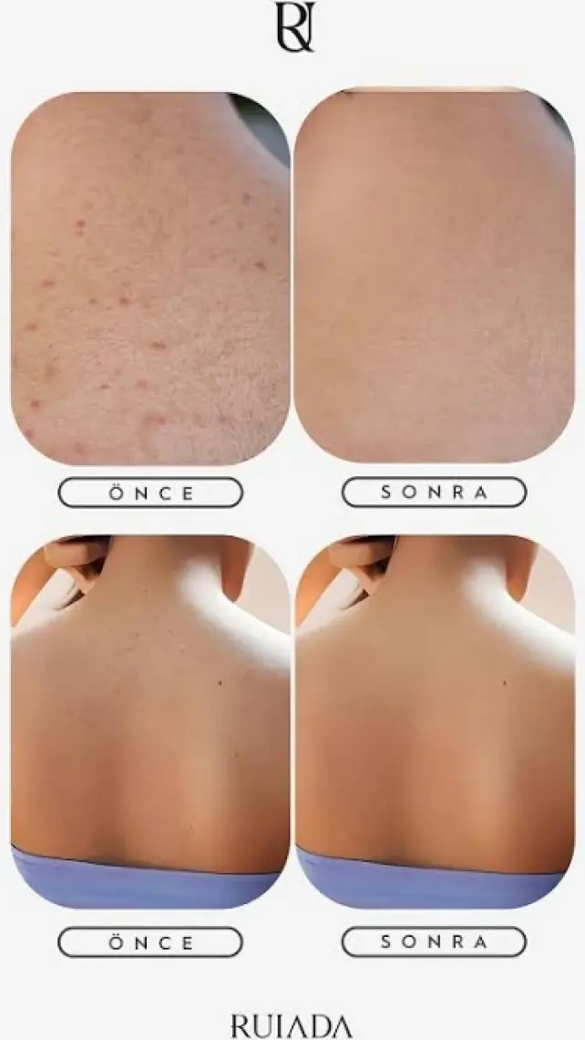 Ruiada +80 Factor Siyah Sırt Banyo Duş Kesesi %100 Floş İpek Peeling