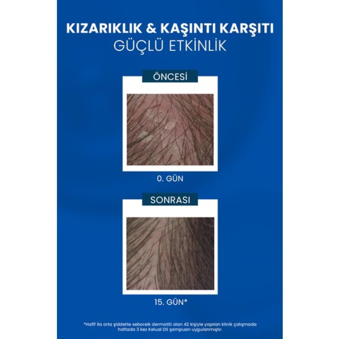 Ducray Kelual DS Yoğun Kepek Önleyici Şampuan - Boyalı Saçlar için Dermatolojik Bakım, 100 ml