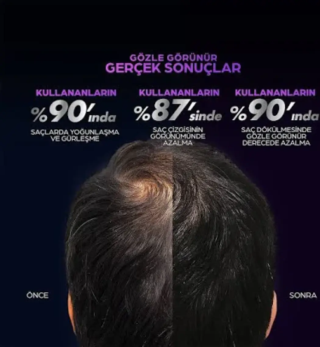 Men Scalp Pro Güçlendirici Serum Saç Dökülmesine Karşı 70 ml